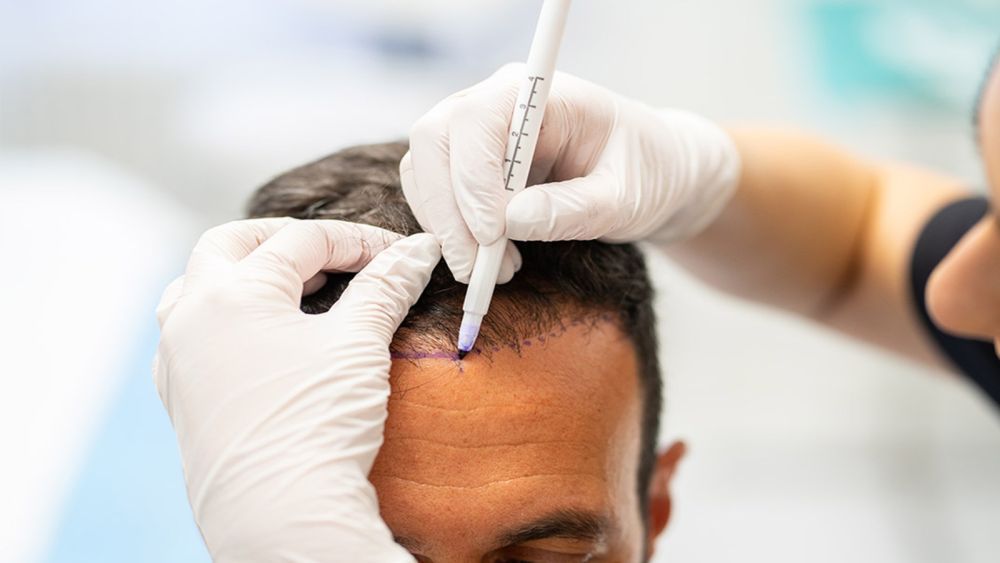 Saç Ekimi ile Yeni Bir Görünüm: Live Hair Clinic Farkıyla Doğal ve Kalıcı Sonuçlar