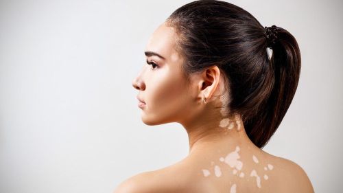 Nişantaşı’nda Excimer Lazer ile Vitiligo Tedavisi