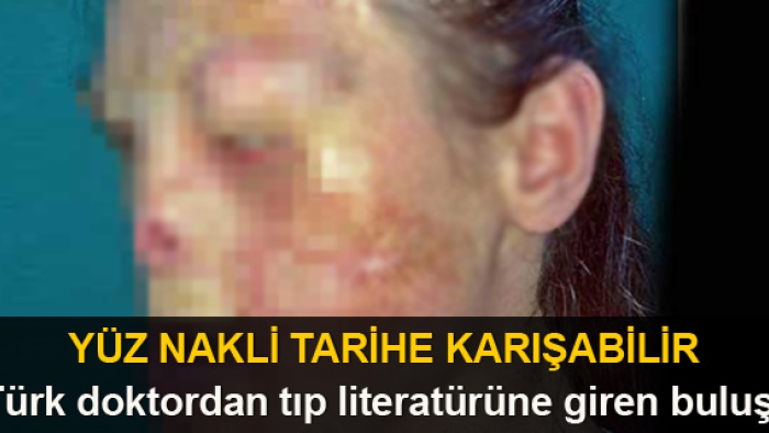 Yüz nakli tarihe karışabilir 